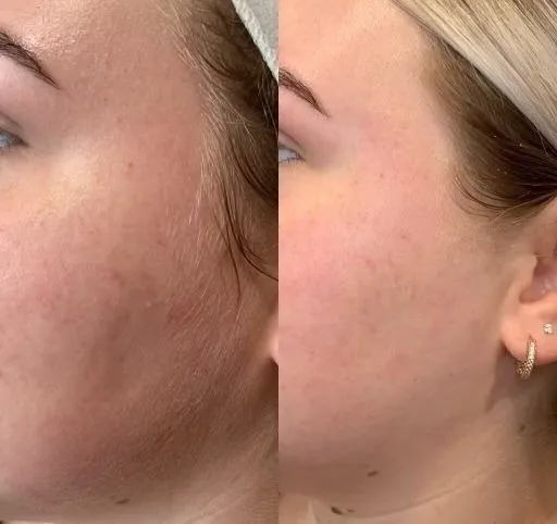 Dermaplaning Results